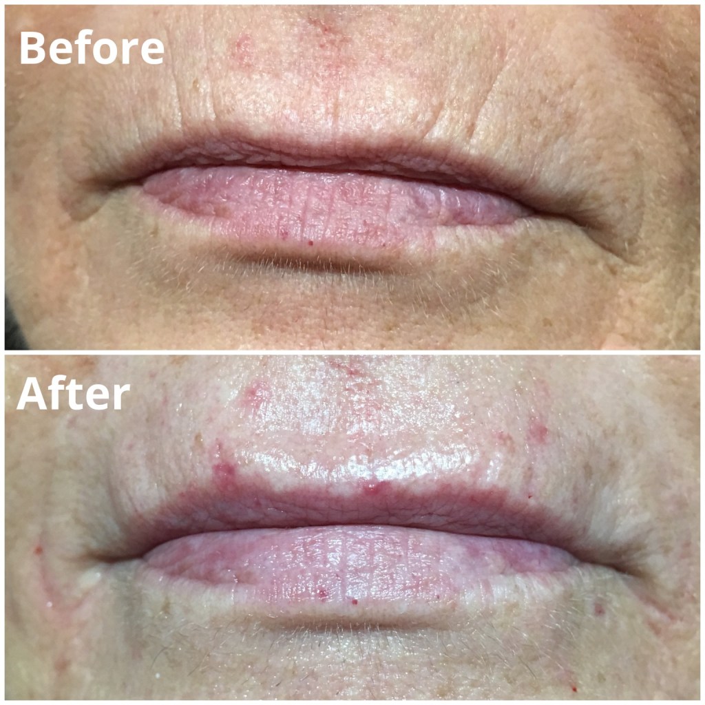 Kiss and Tell Unmasking the Potential Risks of Lip Fillers Dermis