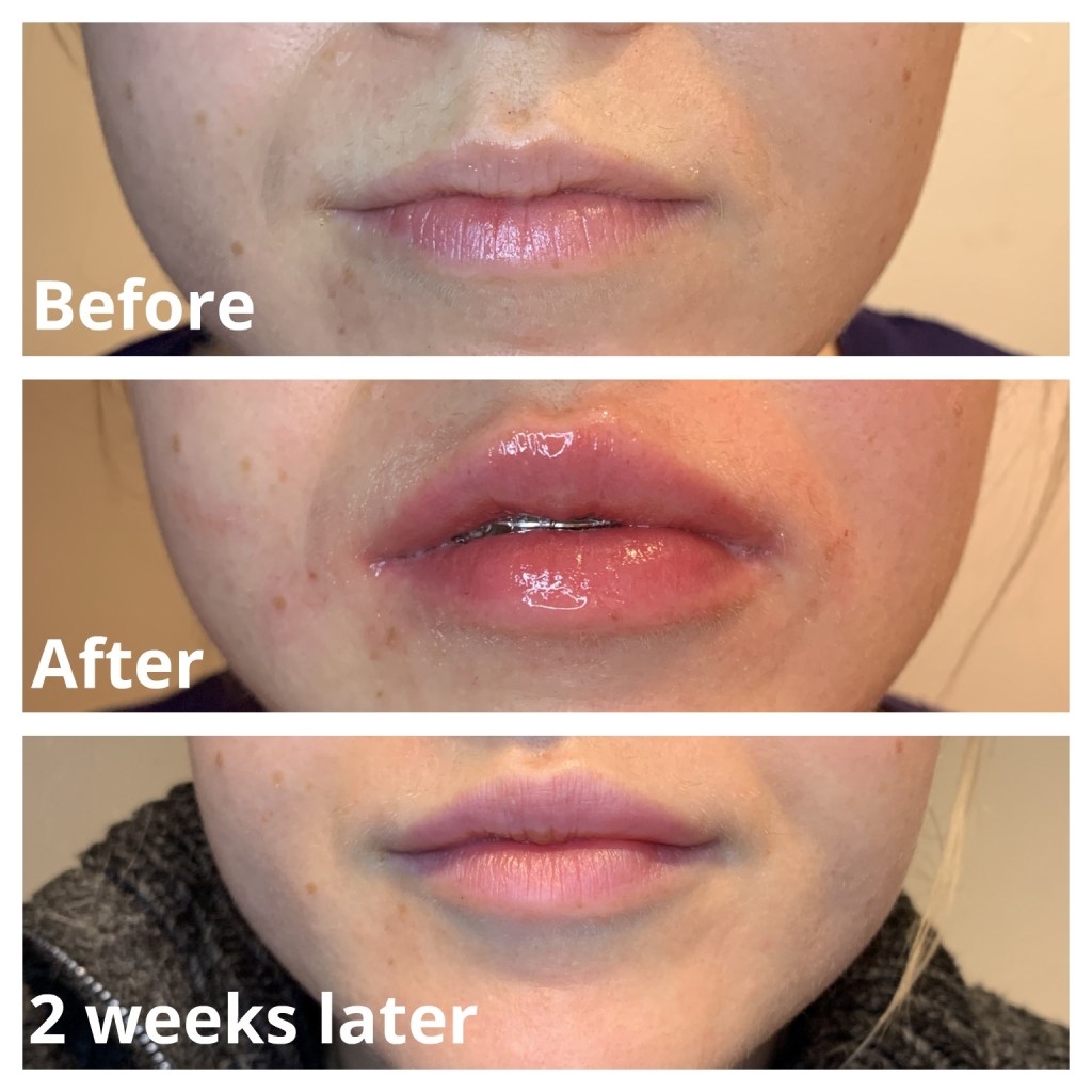 Kiss and Tell Unmasking the Potential Risks of Lip Fillers Dermis
